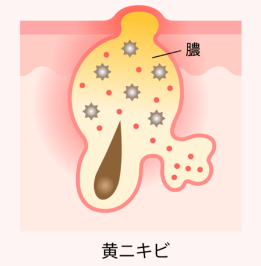 【院長が解説】美容鍼でニキビ（尋常性ざ瘡）は改善できる？効果や通院頻度ご紹介