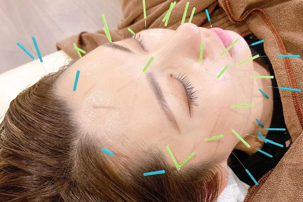 美容鍼の施術
