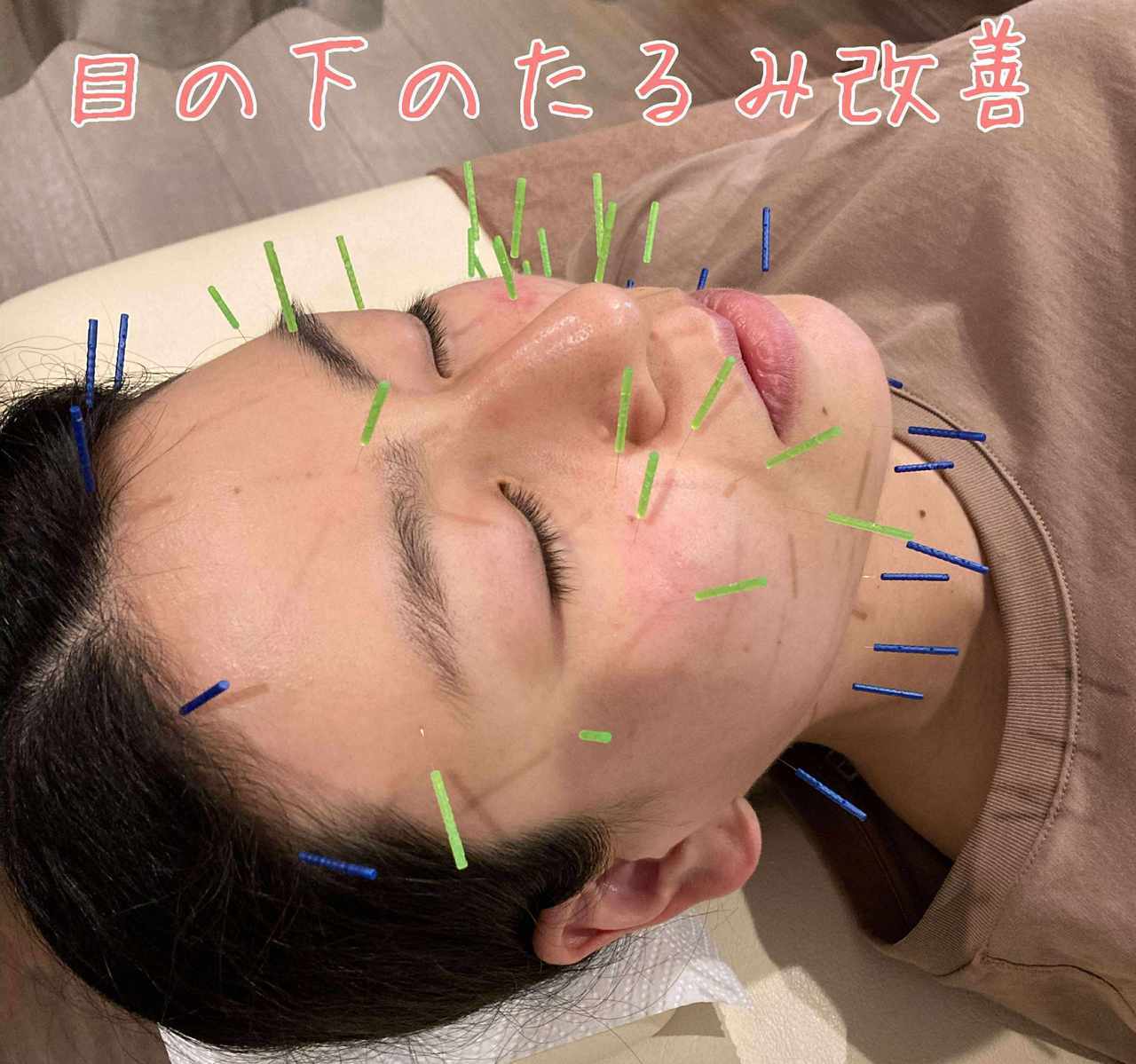 美容鍼による目の下のたるみの改善
