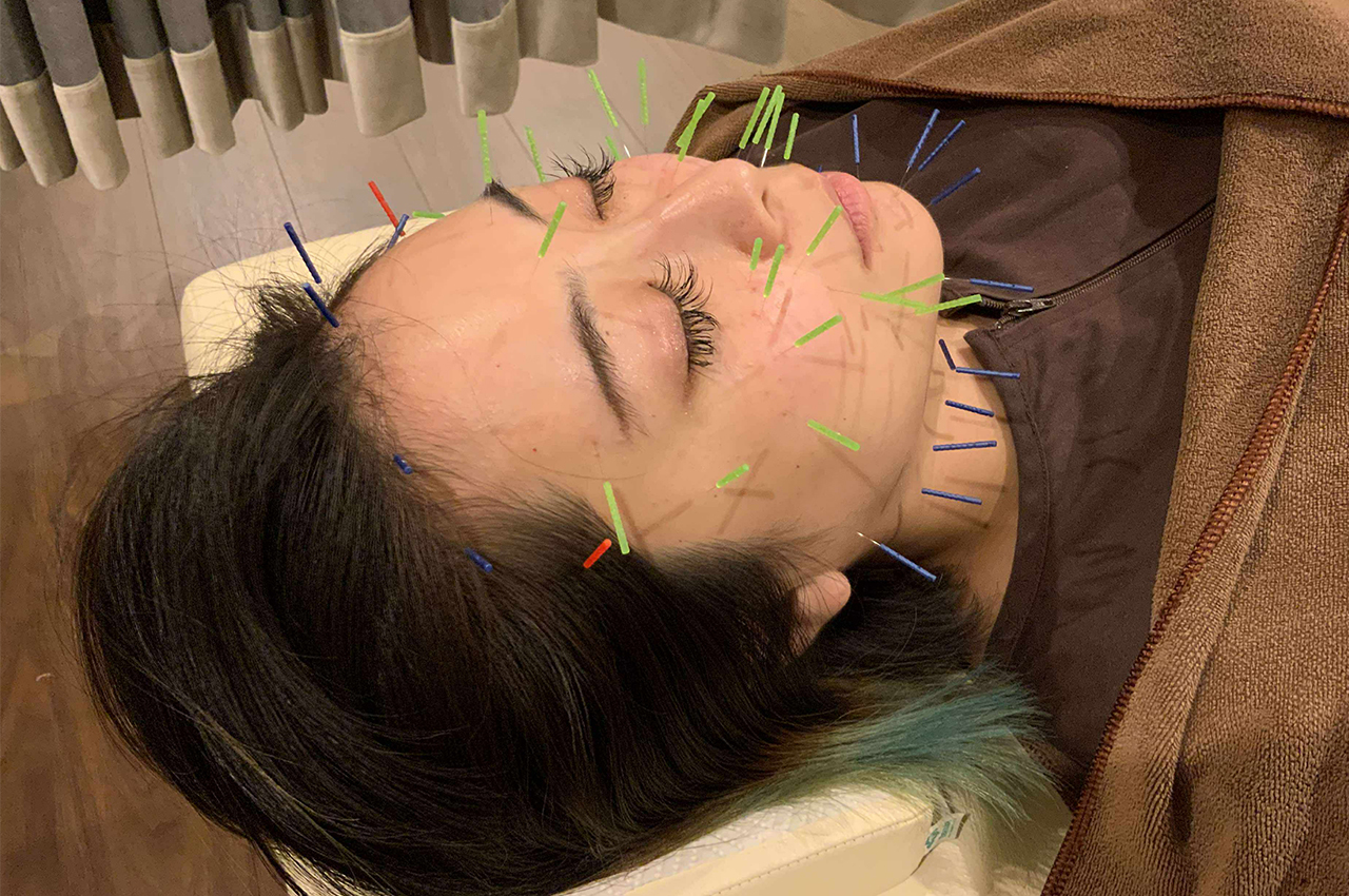 顔のむくみに対する美容鍼の施術2