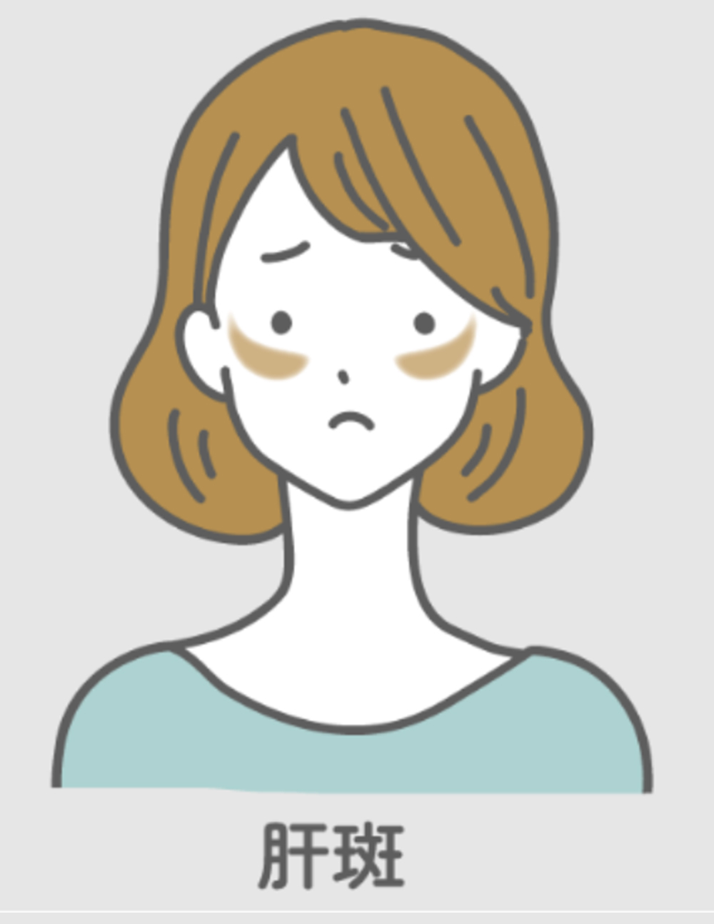 肝斑（かんぱん）