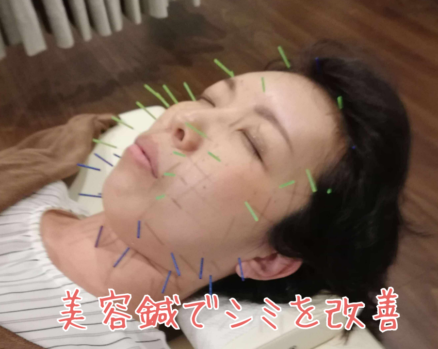顔のシミに対する美容鍼の施術