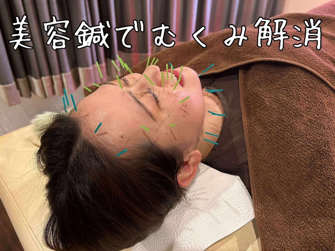 美顔鍼の施術‐顔のむくみ