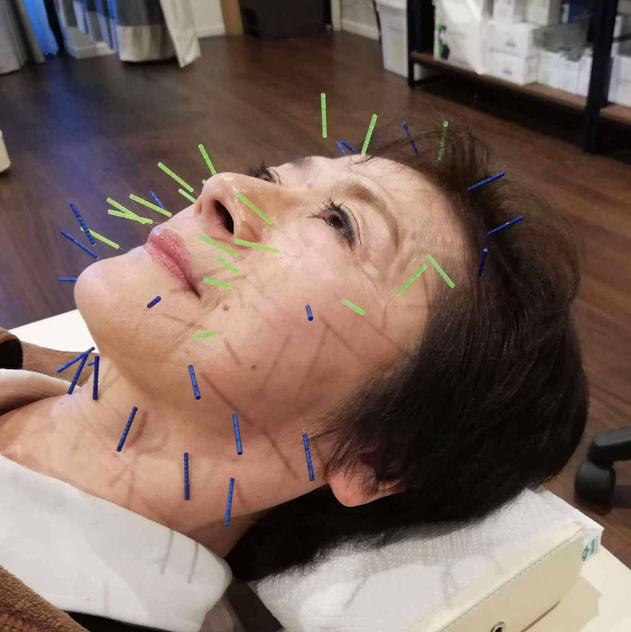 シミ改善