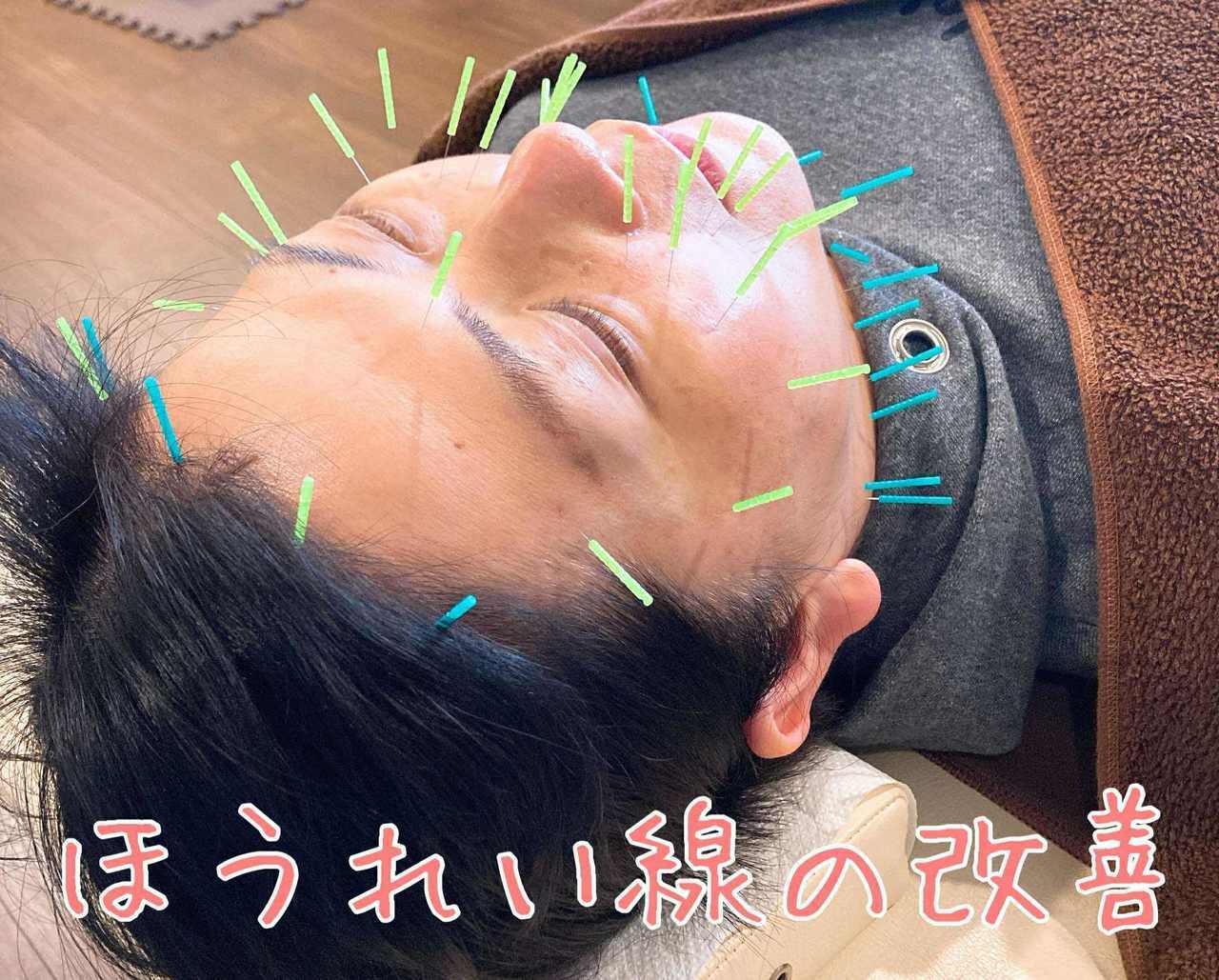美容鍼によるほうれい線の改善