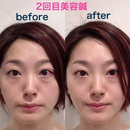 美容鍼　お客様の声　かいまゆ様