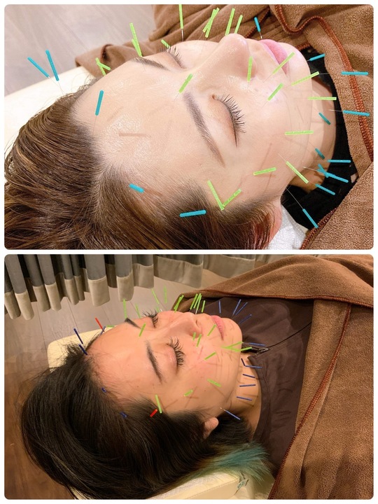 美容鍼灸の施術