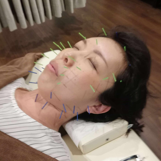 美顔鍼の施術‐顔のシミ
