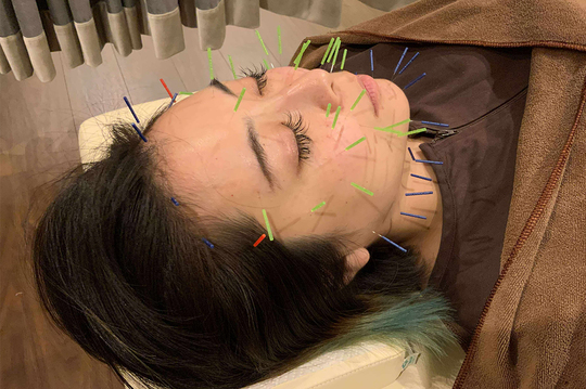 顔のむくみに対する美容鍼の施術2