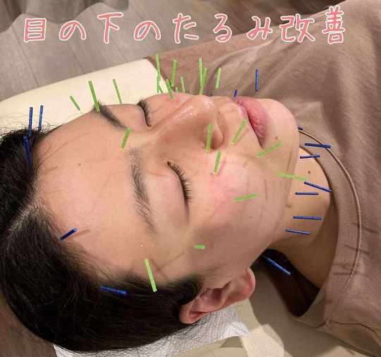 美容鍼で目の下のたるみを改善