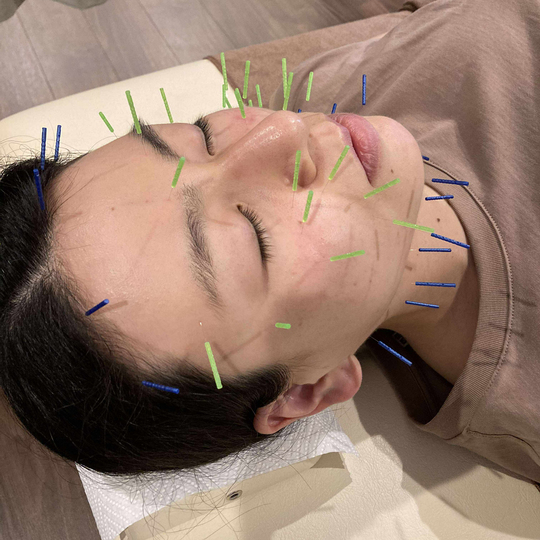 美顔鍼の施術‐くすみ・肌荒れ