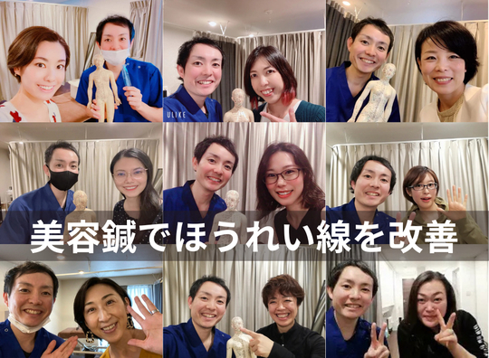 美容鍼によるほうれい線の改善