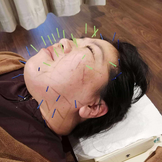 フェイスライン改善