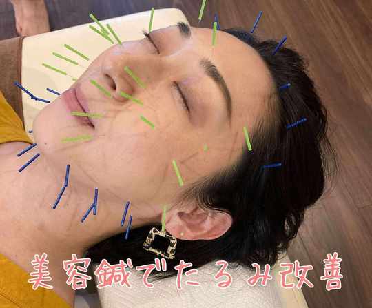 美顔鍼の施術‐顔のたるみ