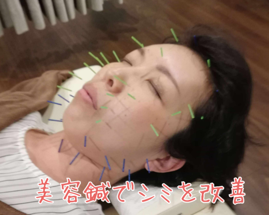院長が解説】美容鍼でシミは改善できる？シミの原因、効果、通院頻度を