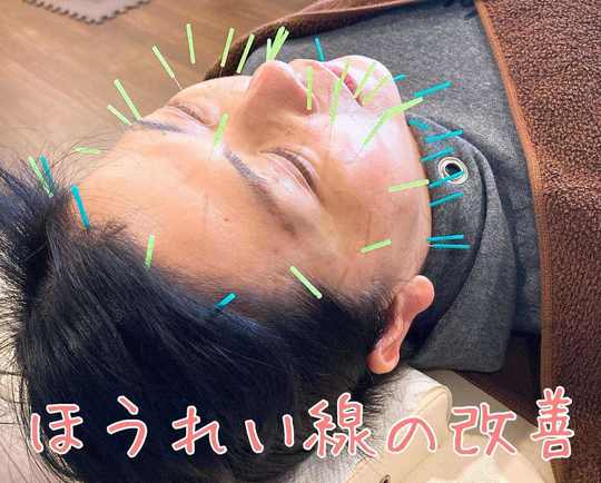 美容鍼によるほうれい線の改善
