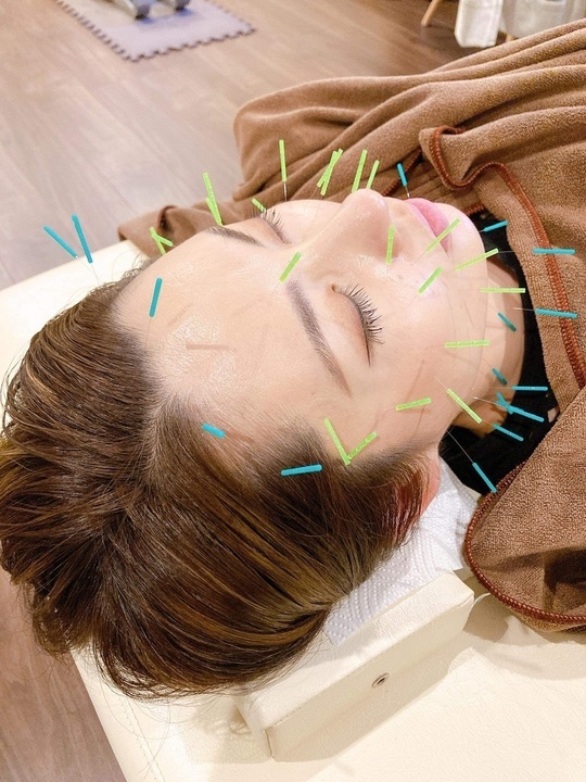 美容鍼による顔のむくみ解消・施術の様子3