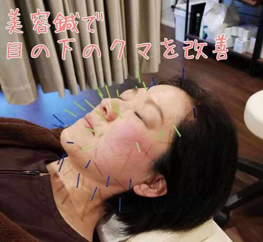 美顔鍼の施術‐目の下のクマ